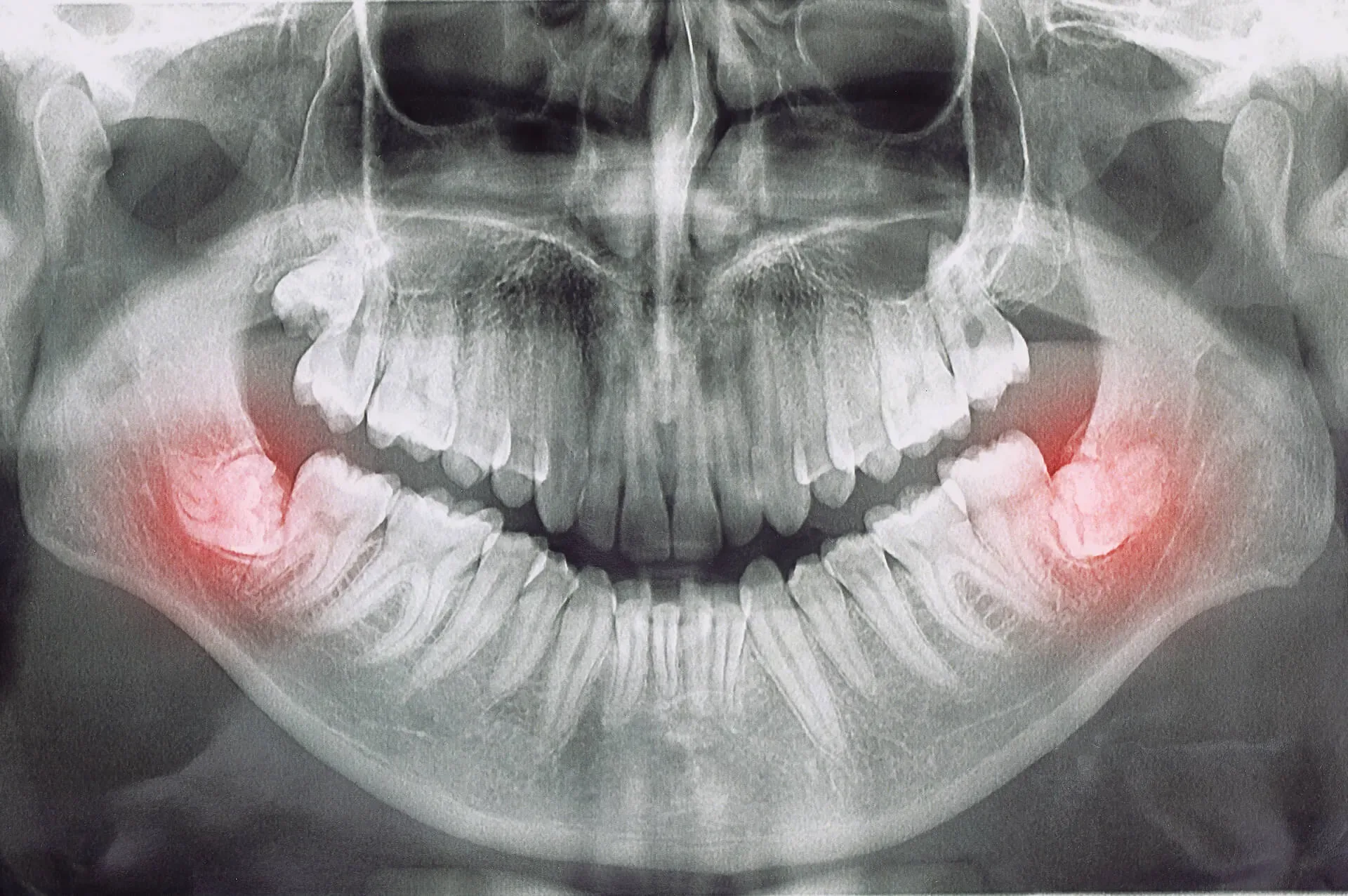 All-On-4 implant retained dentures Classic Dental Care Gilbert