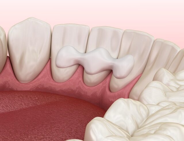 Teeth Bonding