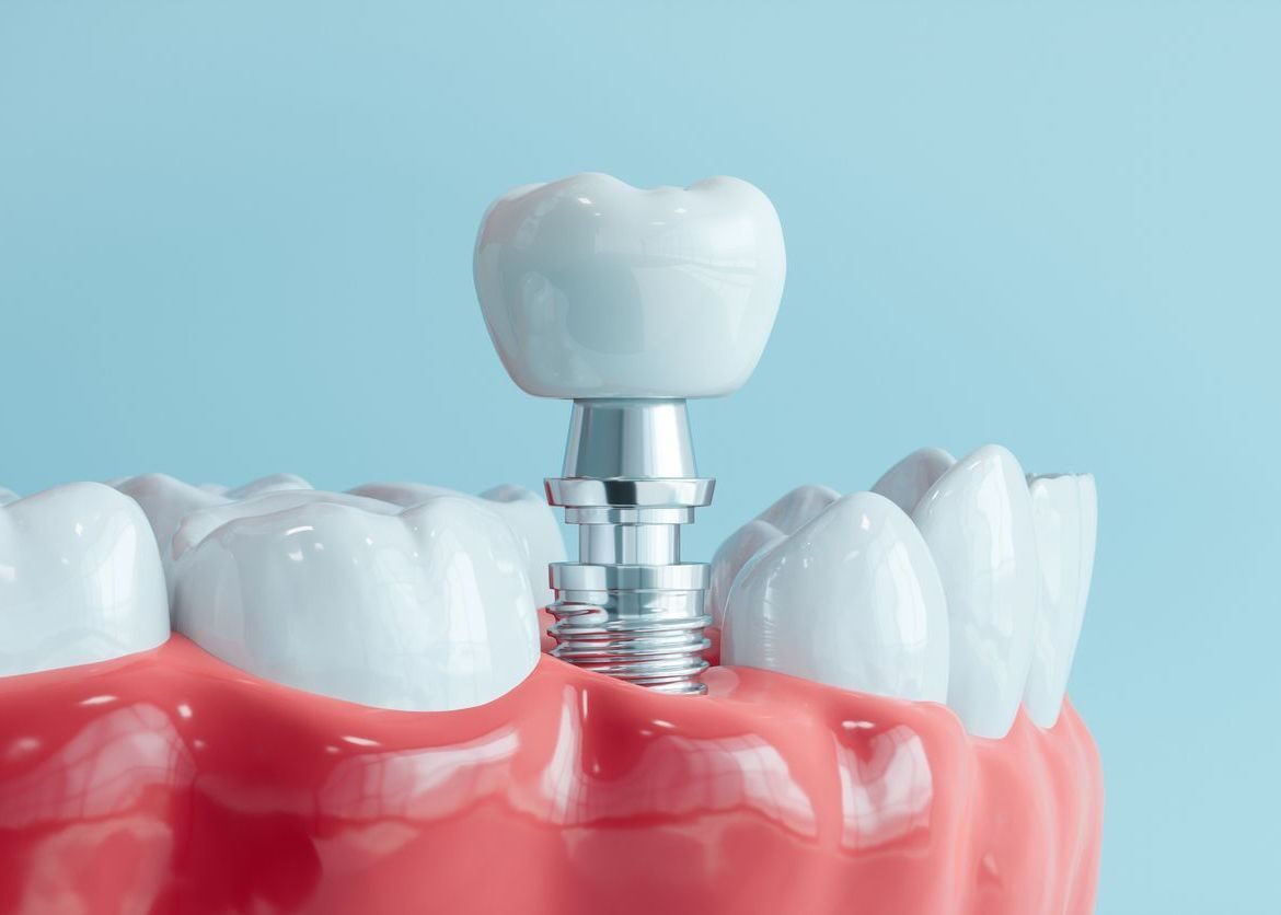 Dental Implant Process