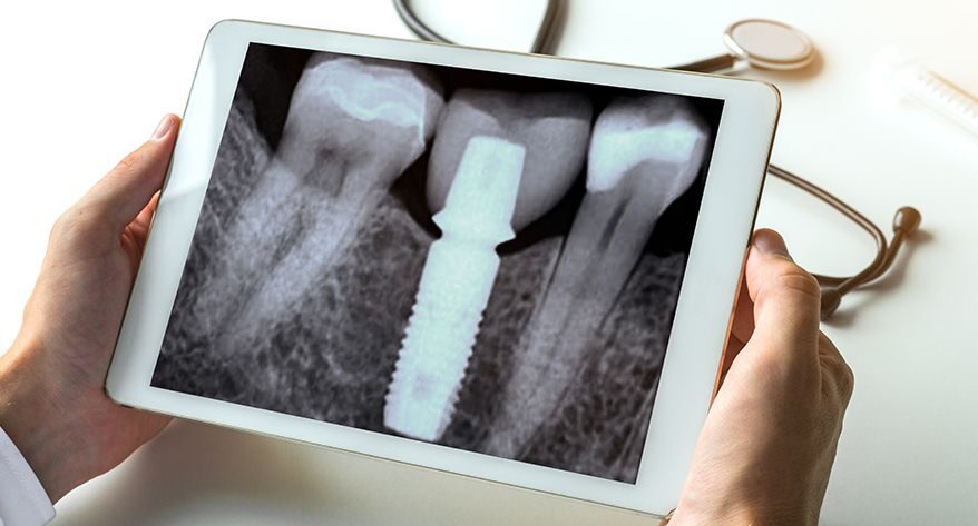 Dental Implants