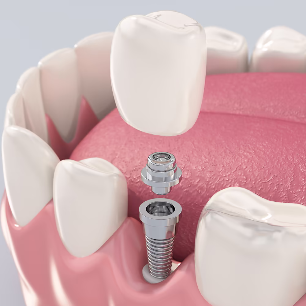 Dental implants at Classic Dental Care Gilbert